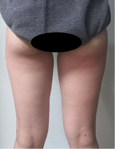 시술 후