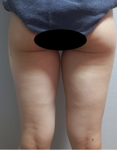 시술 전