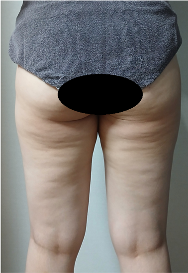 시술 후